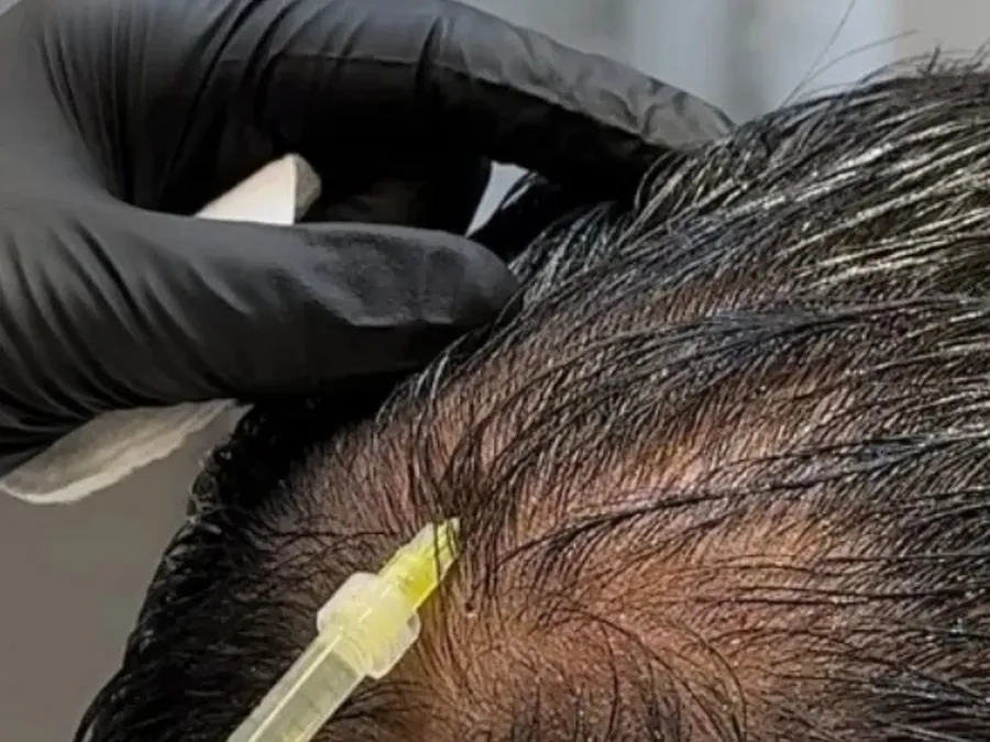 Aplicação de intradermoterapia capilar no Instituto Elévia
