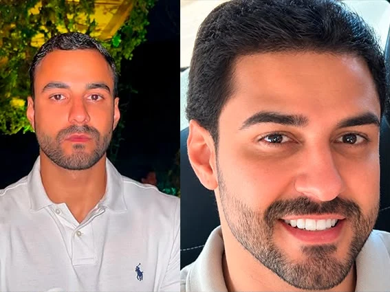 Antes e depois de transplante capilar: densidade recuperada na linha frontal e nas têmporas