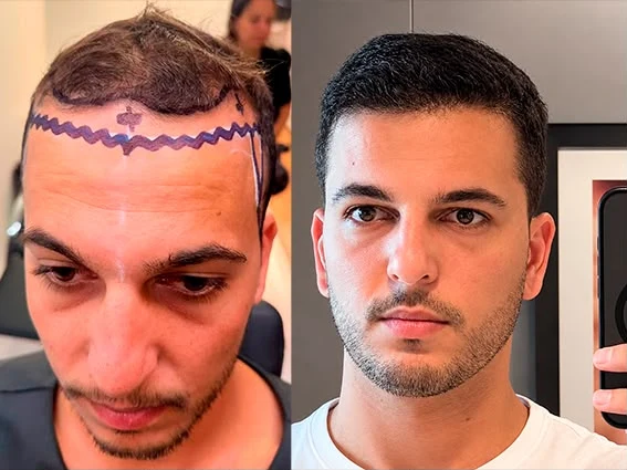 Antes e depois de transplante capilar: marcação cirúrgica da linha frontal e resultado final