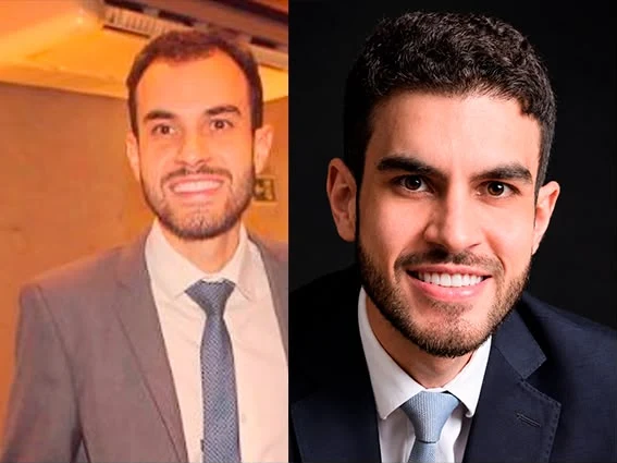 Antes e depois de transplante capilar: cabelo mais cheio e definido