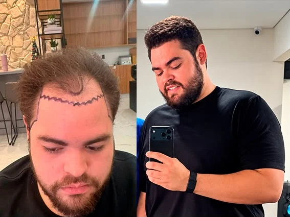 Antes e depois de transplante capilar: marcação pré-cirúrgica e densidade frontal recuperada