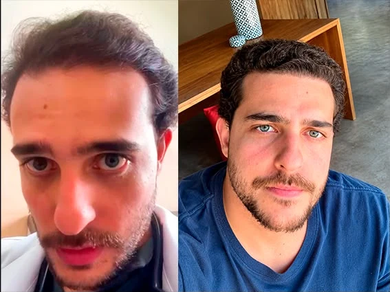 Antes e depois de transplante capilar: reentrada nas têmporas recuperada e volume reforçado